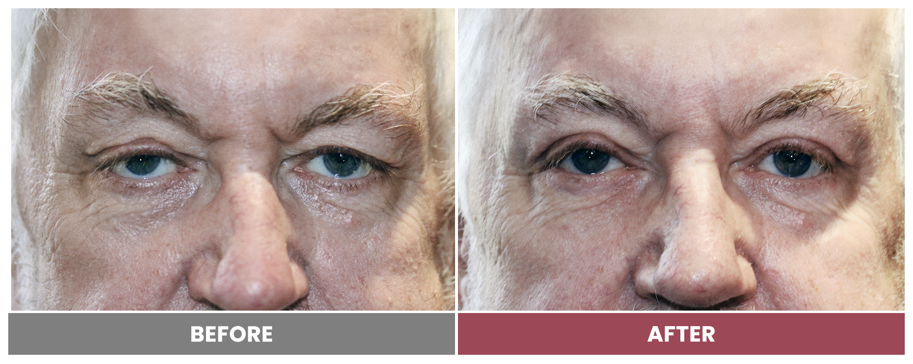 Upper Blepharoplasty - Case 83